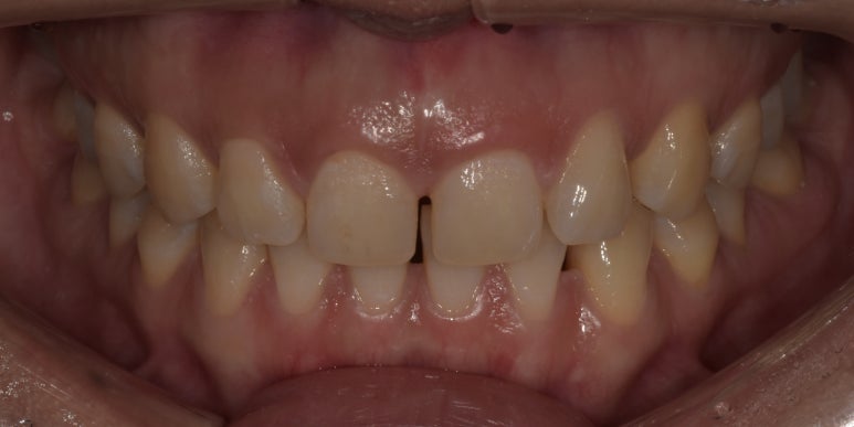 치간이개라미네이트, 벌어진 앞니 개선한 최신사례 관련 이미지 4