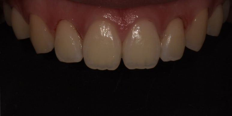 잇몸성형과 잇몸보톡스, 어떤 차이가 있는걸까요? 관련 이미지 12