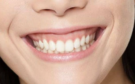 서초역 치과 잇몸성형, 이런 사소한 것 때문에 치과를 가도 되나 싶으셨죠? 관련 이미지 2