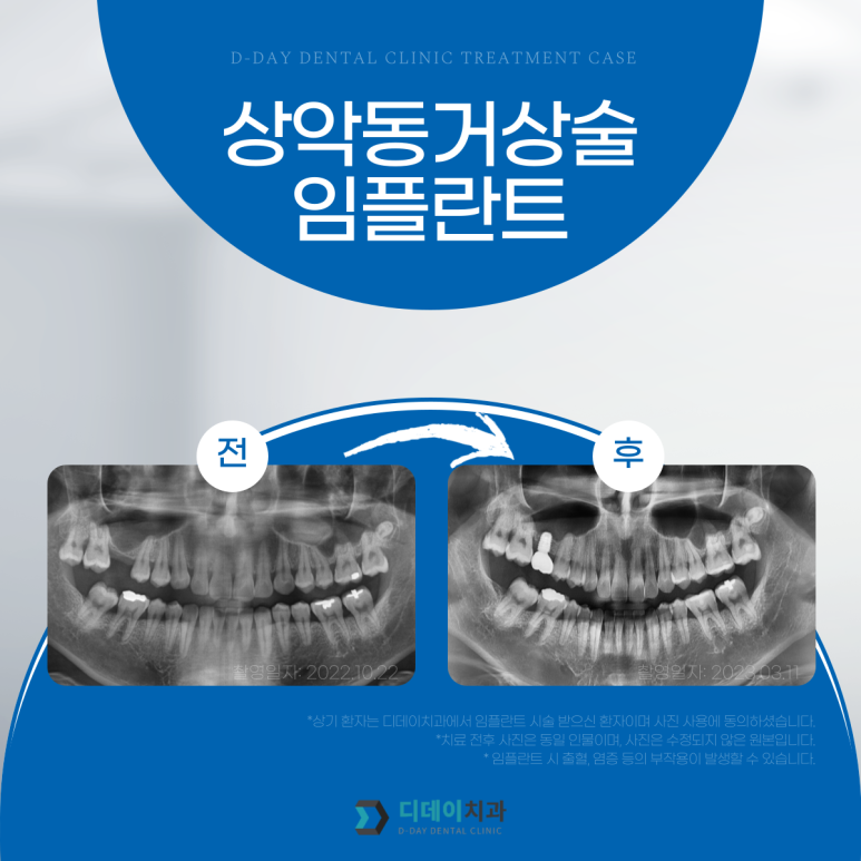 임플란트싼곳? 가격만 보다가 후회할 수도 있습니다 관련 이미지 3
