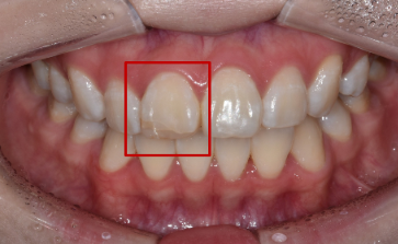 인레이통증? 치료 후 3일 이상 계속되는 분은 보세요. 관련 이미지 3
