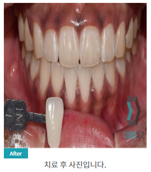 프로필 촬영 전 치아미백 꼭 필요할까요? 관련 이미지 6