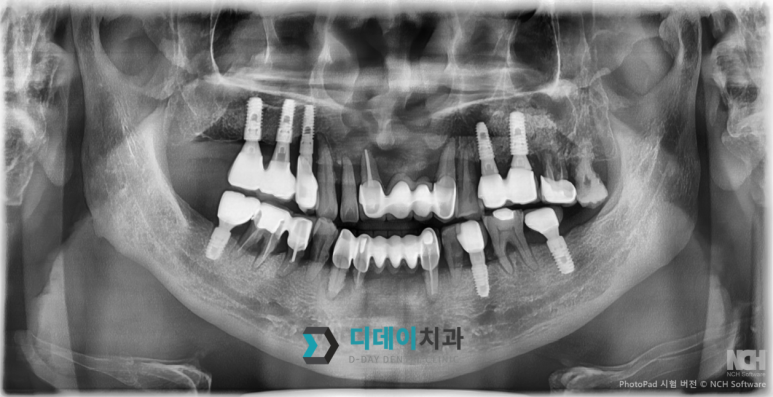 개포동치과, 임플란트 잘하는 곳의기준 3가지 〈필독〉 관련 이미지 3