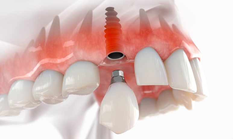 임플란트 영구적으로 사용할 수 있을지 궁금한 분만 <필독> 관련 이미지 1