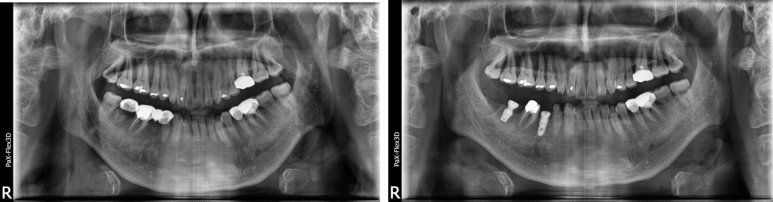 임플란트기간과 내원횟수는 얼마나 될까? 관련 이미지 8