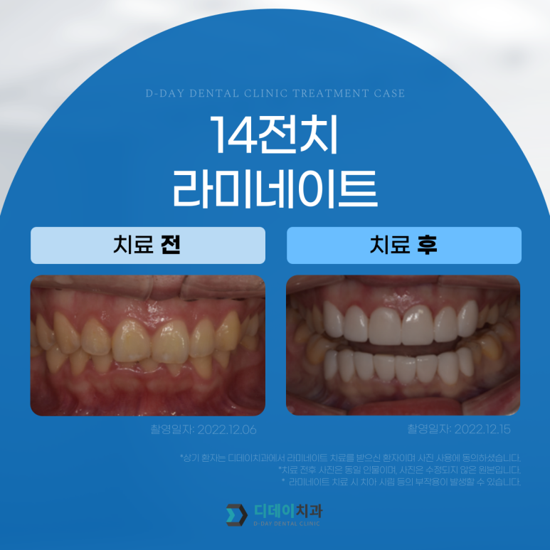 강남라미네이트 잘하는 곳 선택법, 치과의사가 알려드립니다. 관련 이미지 5