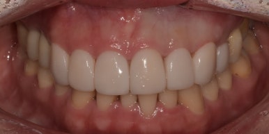 라미네이트후기, 닳아있고 변색된 치아 치료한 최신사례 관련 이미지 7