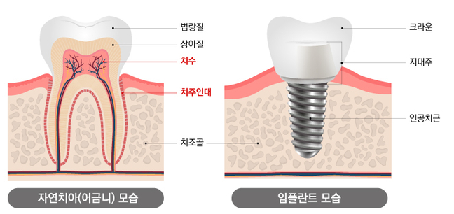 임플란트시술주의사항, 모르면 10년 못 쓰는 이유 관련 이미지 6