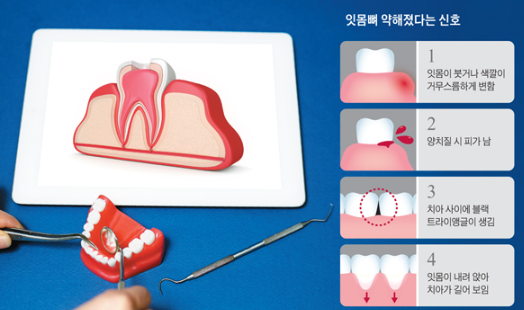 치주염치료비용보다 관련 이미지 3