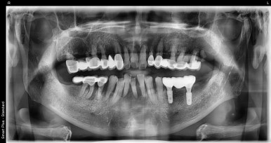 보험임플란트, 임플란트브릿지로 치료한 사례 보여드립니다. 관련 이미지 7