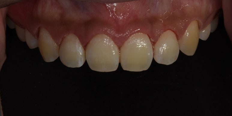 잇몸성형, OO해서 후회해요&hellip; 후회하는 이유는? 관련 이미지 10