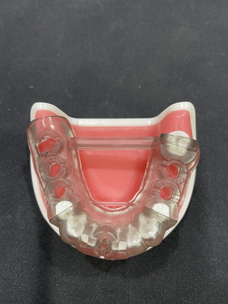 네비게이션임플란트가격, 일반 임플란트보다 비싼 이유? 관련 이미지 3