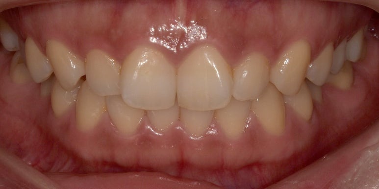 라미네이트 #내돈내산 찐후기 (feat. 직원이 받은 솔직후기2) 관련 이미지 1