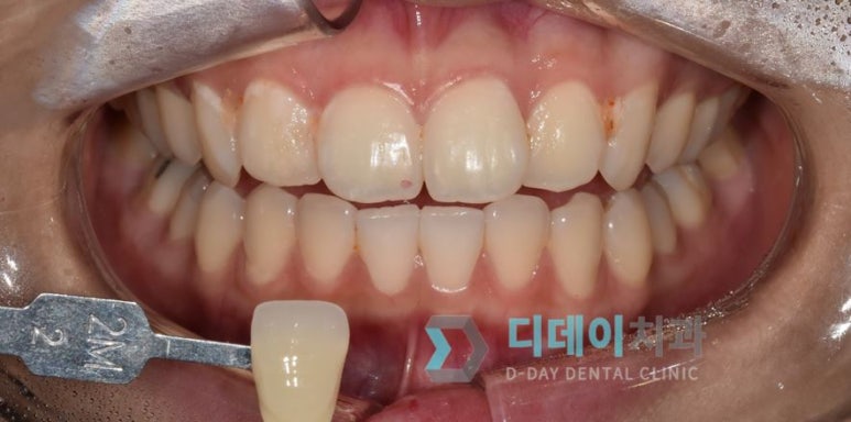강남치아미백, 금세 또 착색되는 이유와 원데이 치료사례 관련 이미지 4