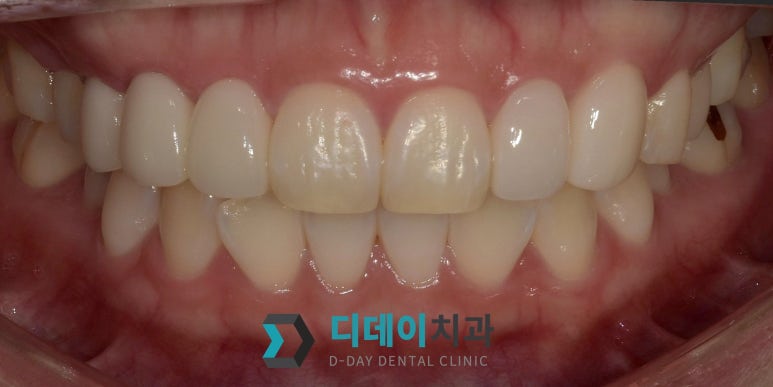 법랑질성형, 라미네이트와 어떻게 다른가요 관련 이미지 4