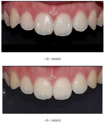 역삼동 연예인 앞니 성형? 1부터 10까지 모두 공개합니다. 관련 이미지 2