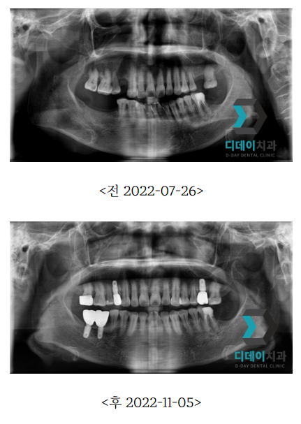 도곡동 충치치료,이에 까만 점이 보인다면? 관련 이미지 4