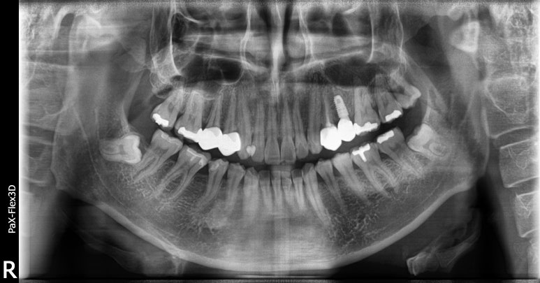 발치즉시임플란트, 아무나 다 되는건 아닙니다. 관련 이미지 5