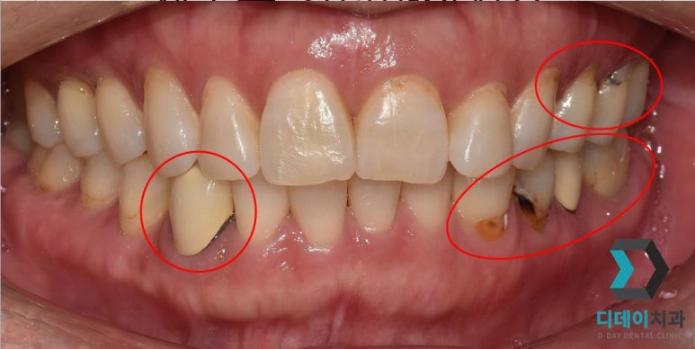 크라운수명, 10년 넘게 쓰고도 교체 안 할 수 있다? 관련 이미지 3