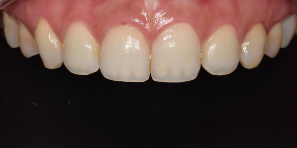 치은절제술/성형술? 잇몸이 치아를 덮고 있어 고민인 분만 관련 이미지 8