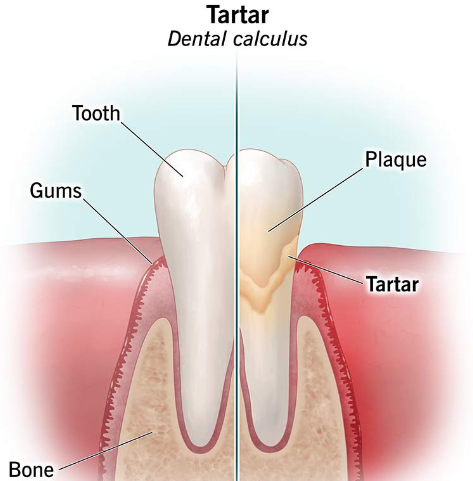 잇몸 부으면 치석 때문? 치아 흔들림의 이유 관련 이미지 3