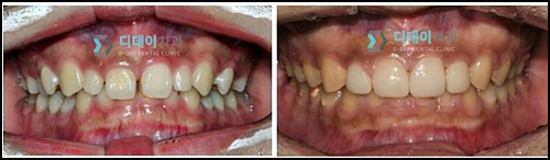 치아사이레진, 재시술을 받지 않으려면 관련 이미지 4