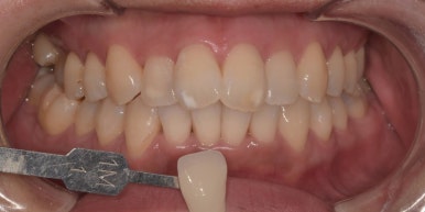 웨딩촬영치아미백? 자신있게, 환하게 웃을 수 있는 꿀팁 관련 이미지 8