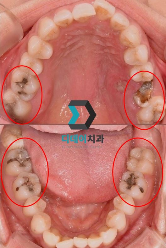 아말감교체, 꼭 해야하나요? 비용은 얼마인가요? 관련 이미지 8