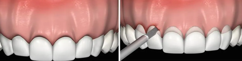 잇몸성형가격, 의사가 알려주는 2가지 확인사항 관련 이미지 3