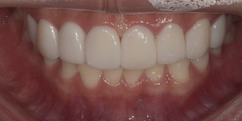 라미네이트 vs 레진 차이점 장단점 완벽 비교 관련 이미지 8