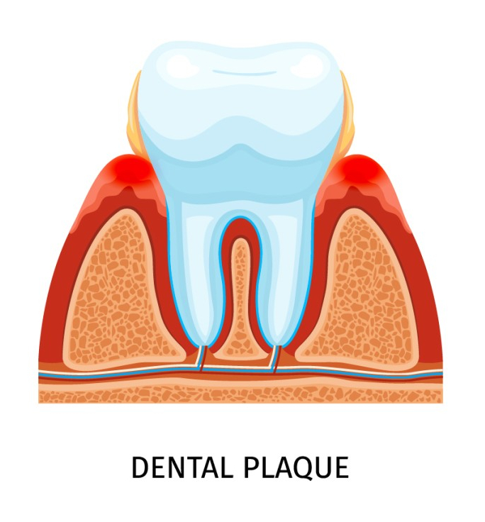 임플란트에도 충치가 생긴다? Yes or No? 관련 이미지 2