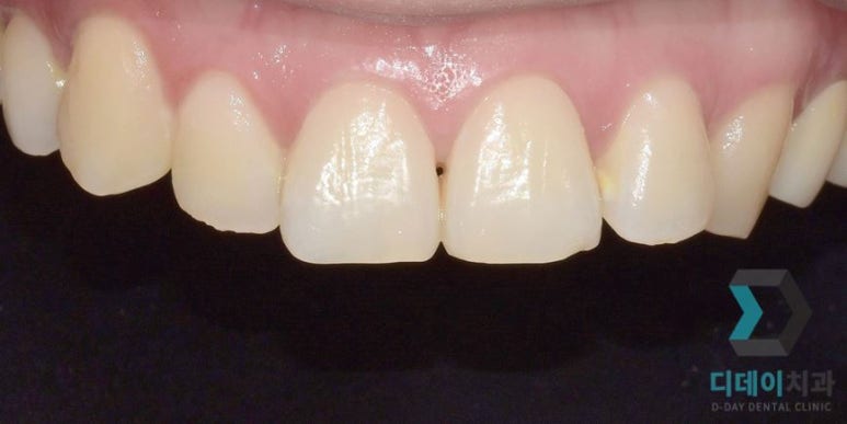 라미네이트후기, 치료사례만 모아 보여드립니다 관련 이미지 13