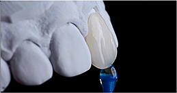 라미네이트시림, 걱정 없이 제대로 치료받는 방법? 관련 이미지 4