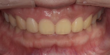 법랑질성형, 잇몸성형, 치아미백까지! 디데이치과 심미치료 총집합 치료사례 관련 이미지 6