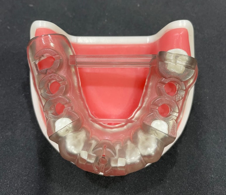 네비게이션임플란트, 무조건 성공하는 것은 아닌 이유? 관련 이미지 4