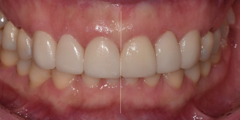 교정후라미네이트? 실제 치료 후기 궁금하신 분만 관련 이미지 7