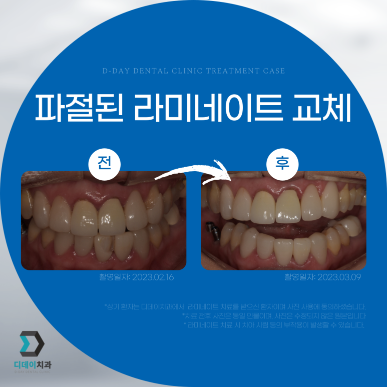 강남라미네이트 잘하는 곳 선택법, 치과의사가 알려드립니다. 관련 이미지 4