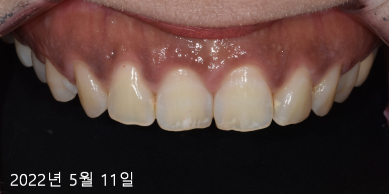 잇몸이 까매요.. 잇몸미백치료 사례 공개합니다 관련 이미지 1