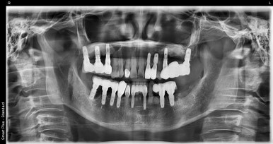 앞니임플란트, 상악동거상술임플란트 비용까지 자세히 설명드립니다. 관련 이미지 4