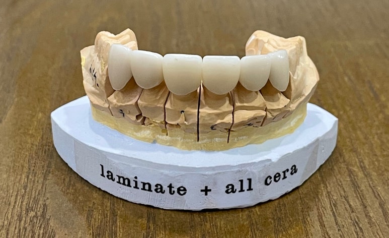 반상치(치아반점)라미네이트, 치료 사례와 비용까지 전격공개 관련 이미지 8
