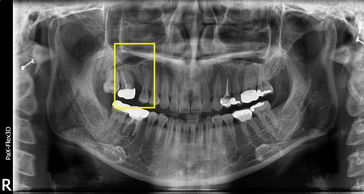 어금니 발치후 임플란트 기간? 식립 시기 모르면 후회합니다 관련 이미지 6