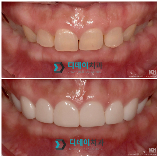 한티역치과, 라미네이트 잘하는 곳 찾기 힘들죠? 의사가 고르는 기준 공개 관련 이미지 6