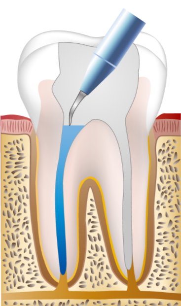 신경치료고통? 통증을 줄이는 방법은 바로 OO입니다. 관련 이미지 9