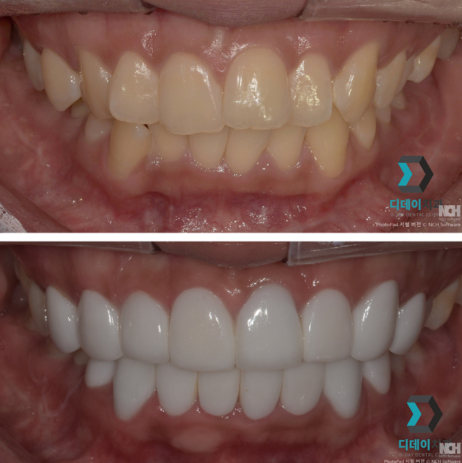 서초동라미네이트, 잘하는 치과특징 3가지 정리했습니다 관련 이미지 6