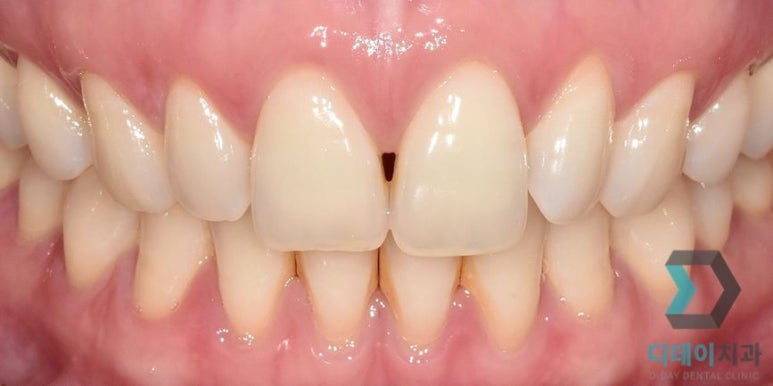 라미네이트후기, 치료사례만 모아 보여드립니다 관련 이미지 3