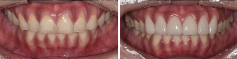 라미네이트색상, 모양 후회 안하려면? 관련 이미지 6