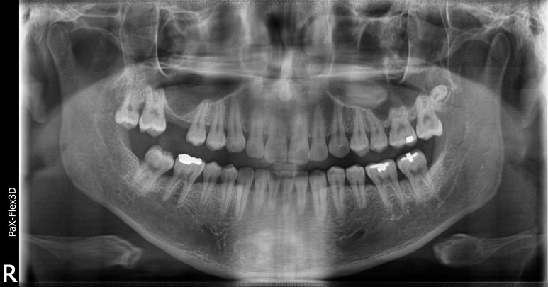 상악동거상술임플란트, 어려운 만큼 제대로 하는 곳을 찾고있다면? 관련 이미지 4