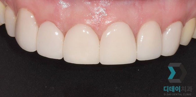 라미네이트후기, 치료사례만 모아 보여드립니다 관련 이미지 14