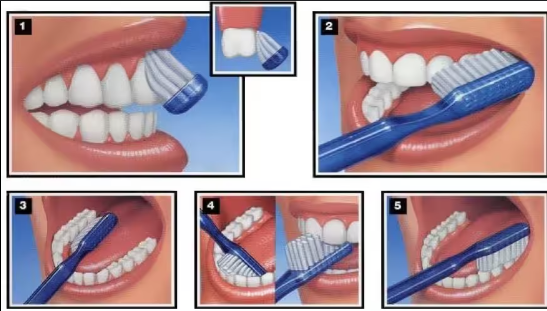 잇몸 부으면 치석 때문? 치아 흔들림의 이유 관련 이미지 7