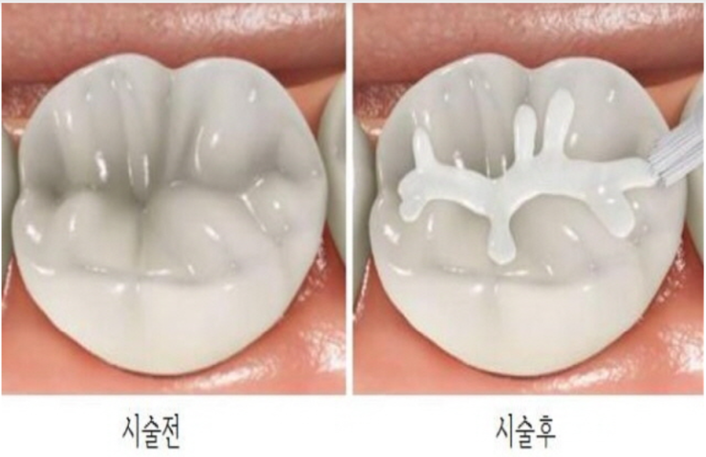 한티역 치과, 충치가 걱정이라면 딱 2가지만 확인해보세요 관련 이미지 2